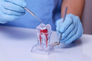 Read more about the article Endodontia