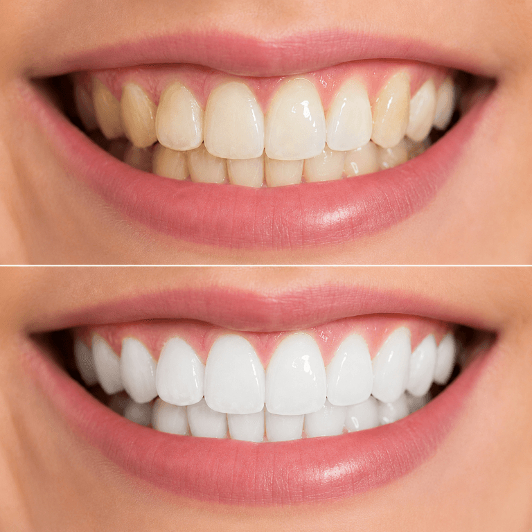 Antes e depois de tratamento de branqueamento dentário